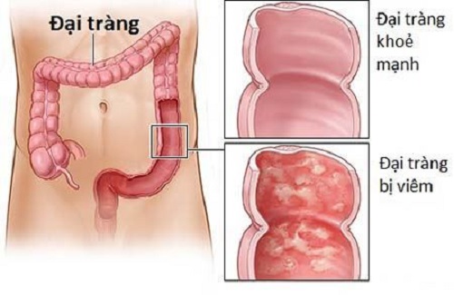 Viêm đại tràng thường có đau bụng kèm theo đi ngoài ra máu