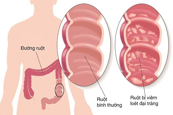 Đau bụng quặn có thể do bạn bị viêm đại tràng mạn tính