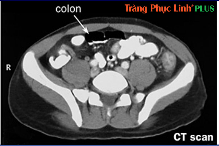 CT-scan