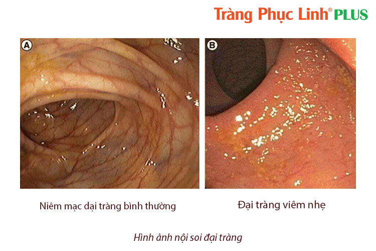 dai-trang-viem-nhe