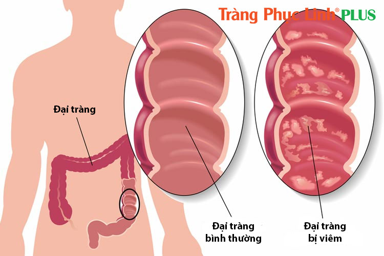 dai-trang-viem