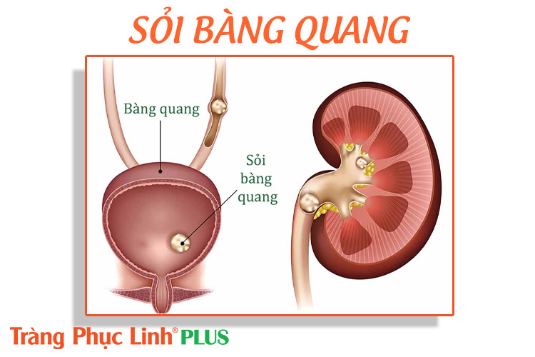 Sỏi bàng quang