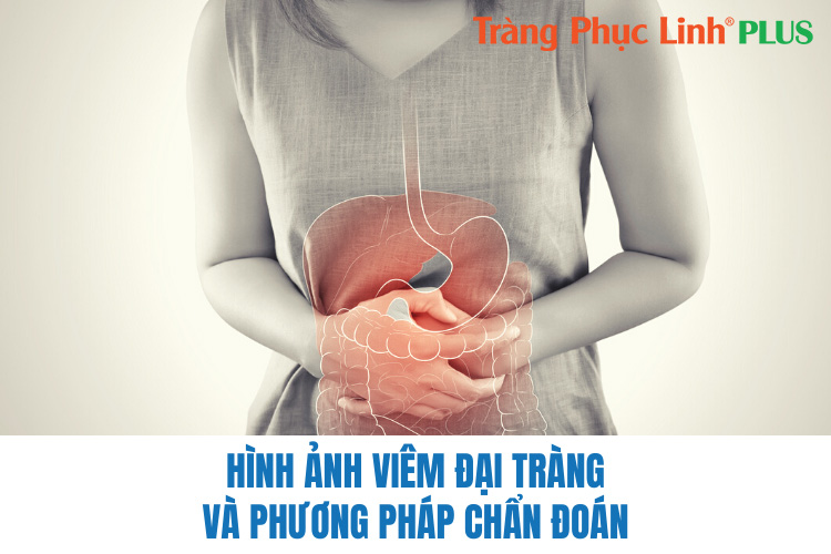 Hình ảnh viêm đại tràng và phương pháp chẩn đoán