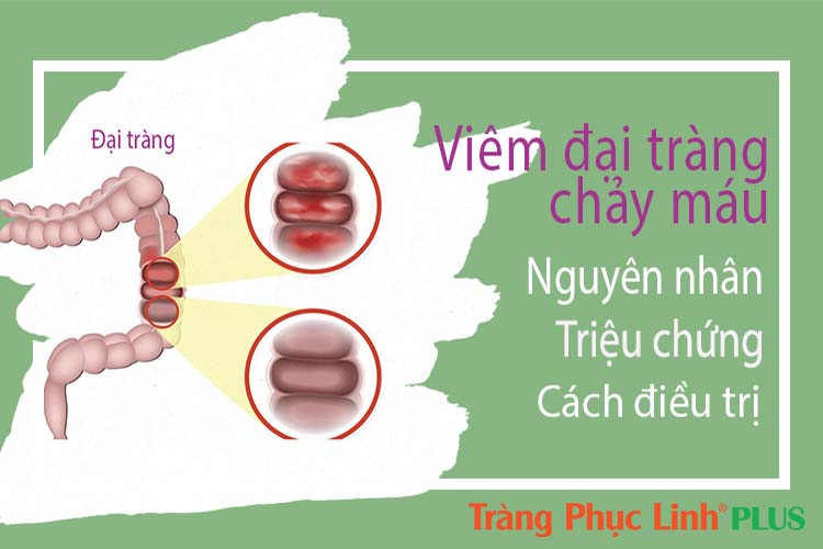 Viêm đại tràng xuất huyết nguy hiểm thế nào?