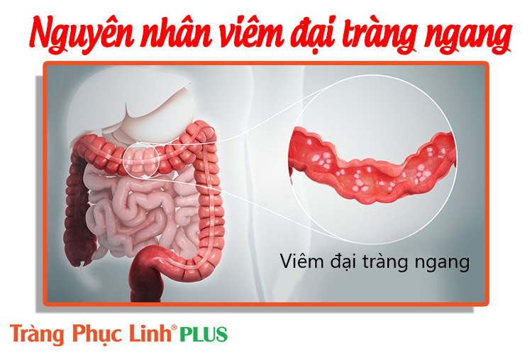 Nguyên nhân gây ra bệnh viêm đại tràng ngang