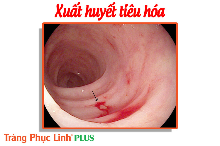 Xuất huyết tiêu hóa