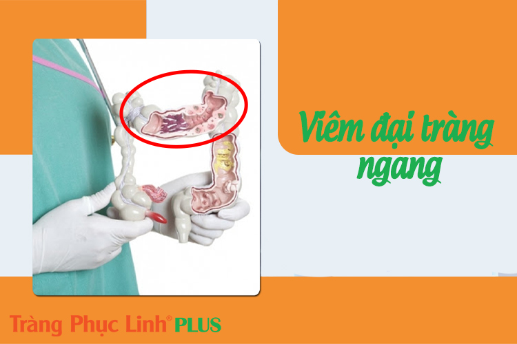 Viêm đại tràng ngang có nguy hiểm không? Cách điều trị