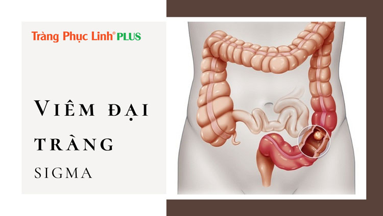 Viêm đại tràng Sigma có nguy hiểm không? Điều trị thế nào?