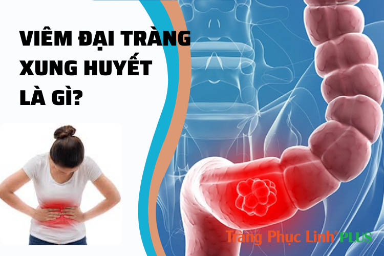 Viêm đại tràng xung huyết là gì? Nguyên nhân và cách điều trị