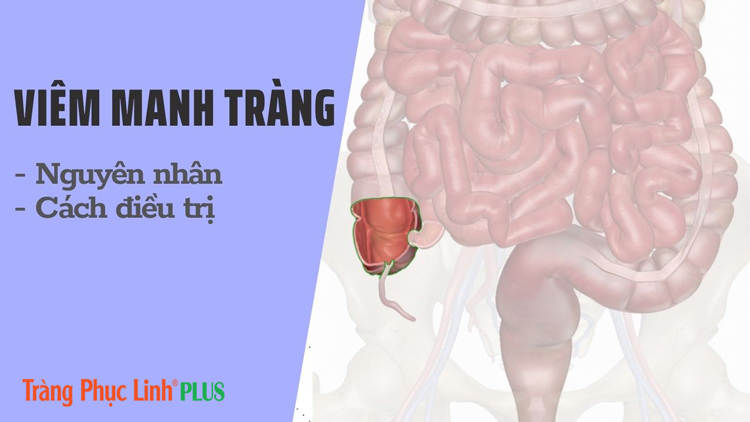 Viêm manh tràng là gì? Nguyên nhân, dấu hiệu và cách điều trị