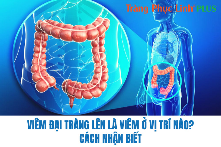 Viêm đại tràng lên là viêm ở vị trí nào? Cách nhận biết