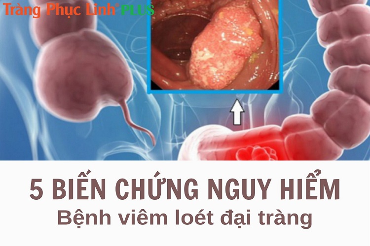 Cảnh báo 5 biến chứng nguy hiểm của viêm loét đại tràng