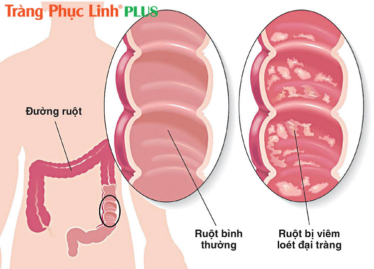 Loet-dai-trang-la-nguyen-nhan-gay-viem