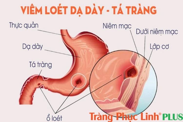 Viem-loet-da-day-ta-trang