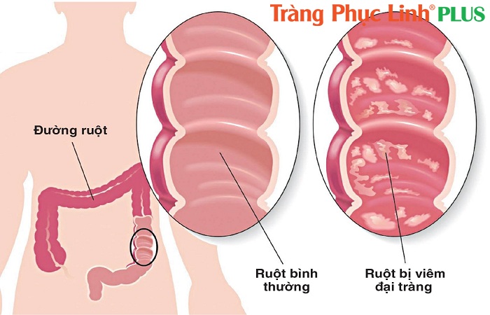 dau bung viem dai trang